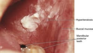 Oral Mucosa